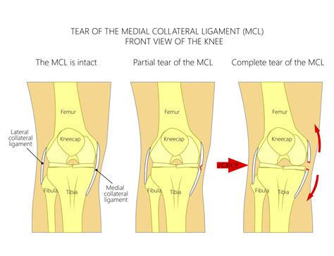 special tests for mcl tear|proximal medial collateral ligament tear.